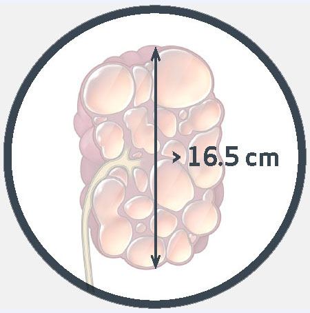 Kidney Length > 16.5 cm